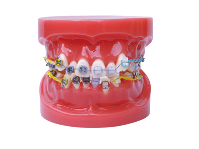 HST-B1-02半金屬半陶瓷托槽