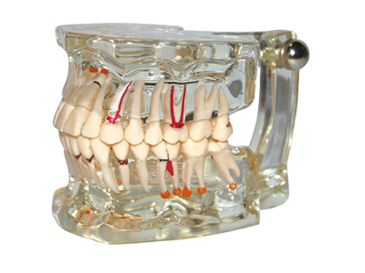 HST-C1 Pathology Model with Half Implant