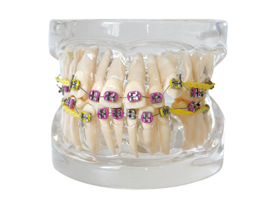 HST-B2-01 全金屬托槽