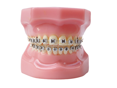 HST-B3-01全金屬托槽